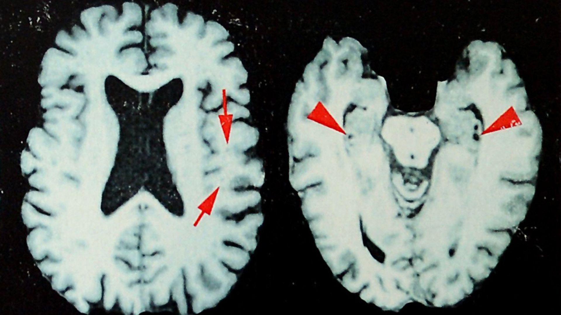 New Study Finds Up to 98% of Recently Died NFL Players May Have Brain Damage